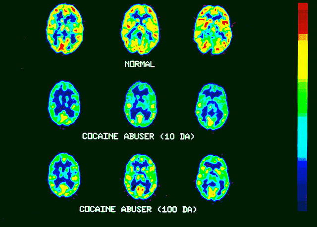 Cocaine Addiction - What Happens in the Brain? Why Is It So Hard to Just Stop?