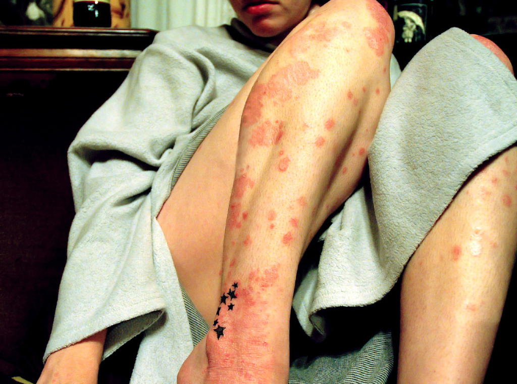 Women Who Drink Beer at Increased Risk of Psoriasis