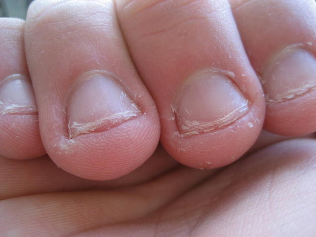 Onychophagia – Nail Biting