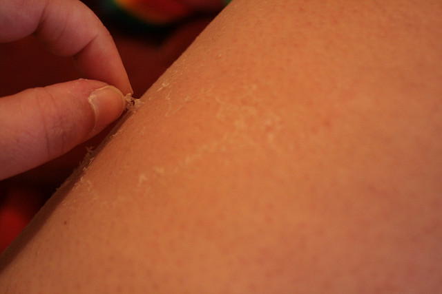 Skin Picking Disorder