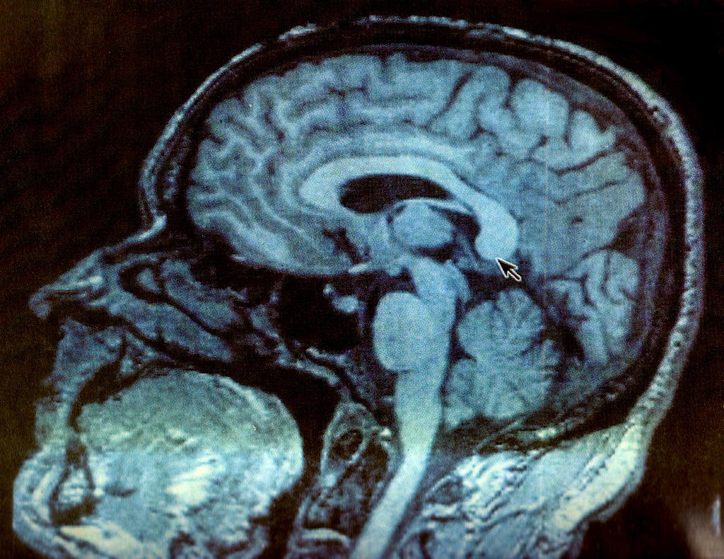 Prenatal Meth Exposure Causes Fetal Brain Damage