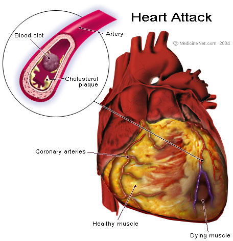 Heavy Drinking, High Blood Pressure and the Risk of Heart Attack and Stroke