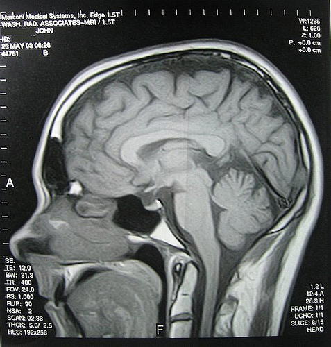 Wet Brain – Alcoholism and Wernicke-Korsakoff Syndrome